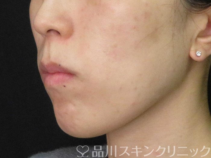 症例NO.65518のBEFORE写真