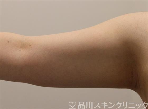 症例NO.45631のAFTER写真