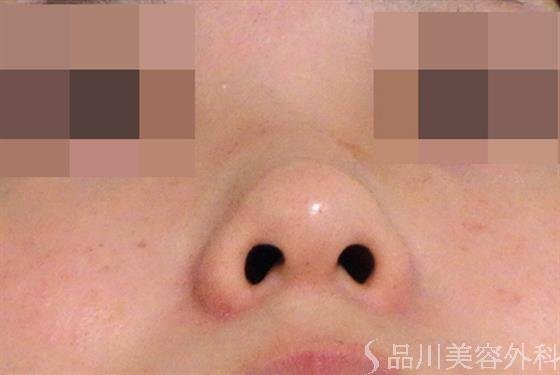 症例NO.39018のBEFORE写真