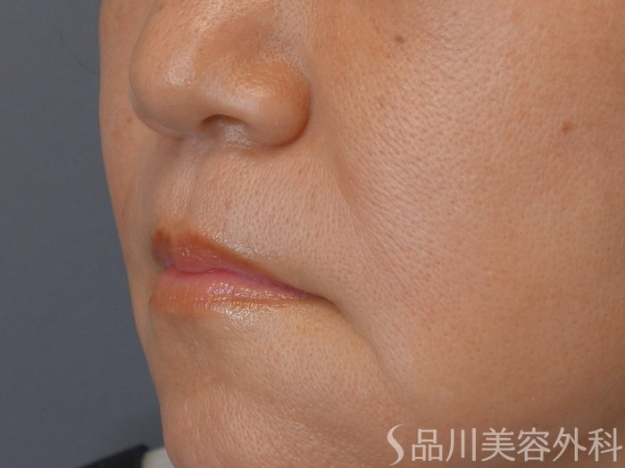 症例NO.71686のAFTER写真
