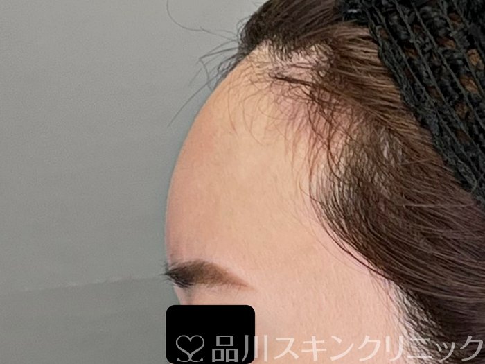 症例NO.69980のAFTER写真