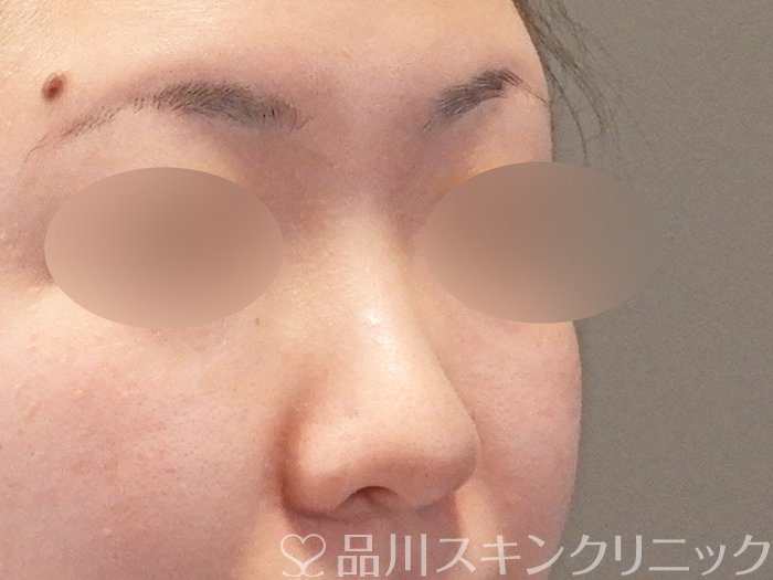 症例NO.64613のBEFORE写真