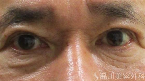 症例NO.55170のAFTER写真