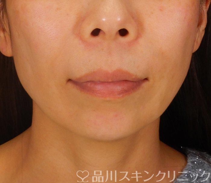 症例NO.66992のBEFORE写真