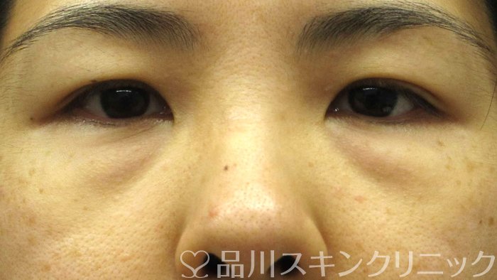 症例NO.69531のBEFORE写真