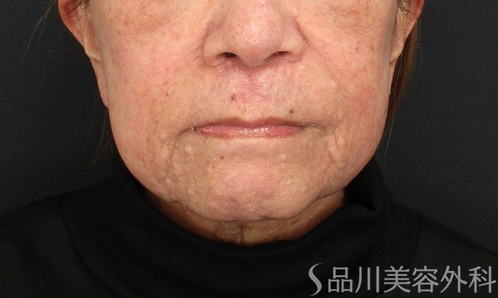 症例NO.75337のBEFORE写真