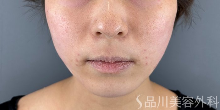 症例NO.71960のAFTER写真