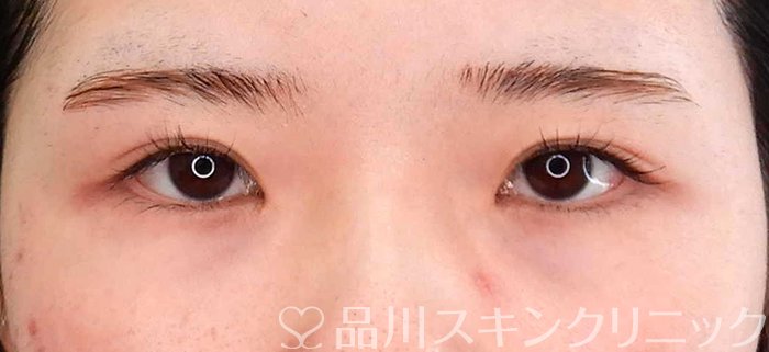 症例NO.63062のBEFORE写真