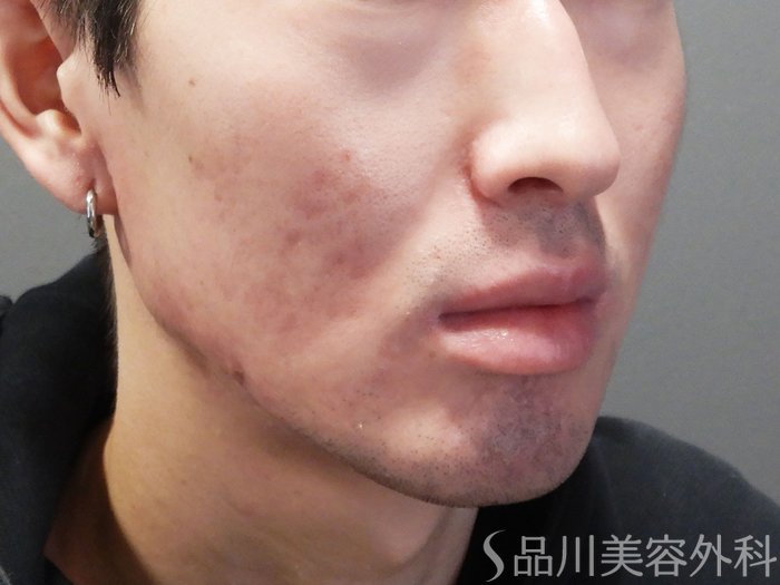 症例NO.72298のAFTER写真