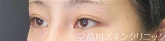 症例NO.59412のAFTER写真