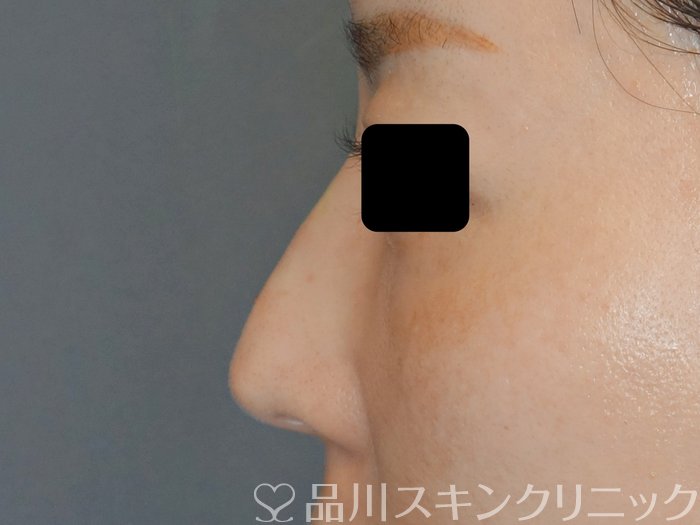 症例NO.71874のAFTER写真