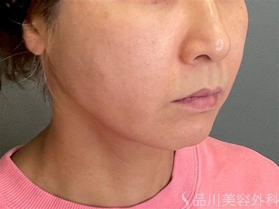 症例NO.51462のBEFORE写真