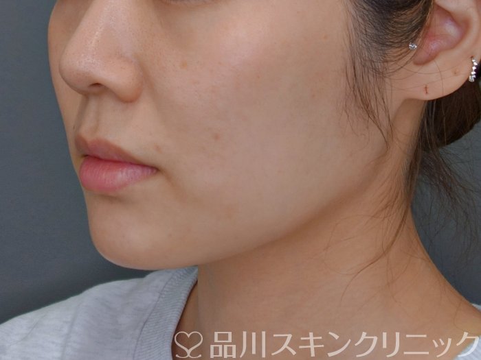 症例NO.73802のAFTER写真