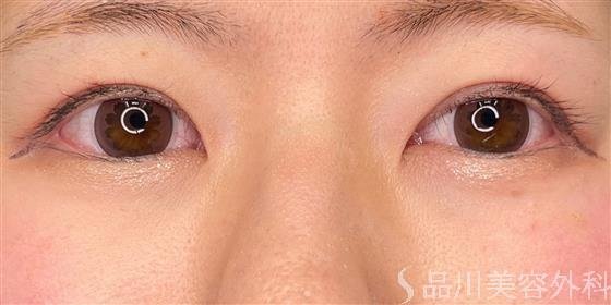 症例NO.61739のBEFORE写真