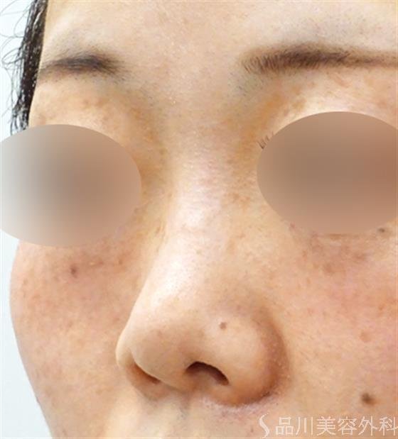 症例NO.50455のBEFORE写真
