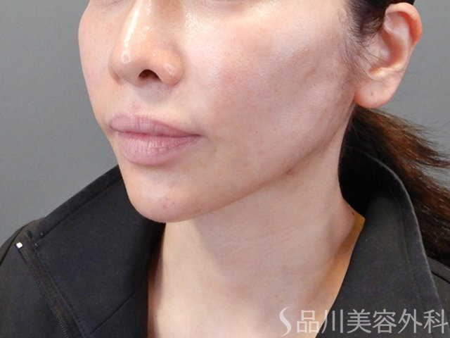 症例NO.68057のAFTER写真