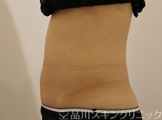 症例NO.75183のBEFORE写真