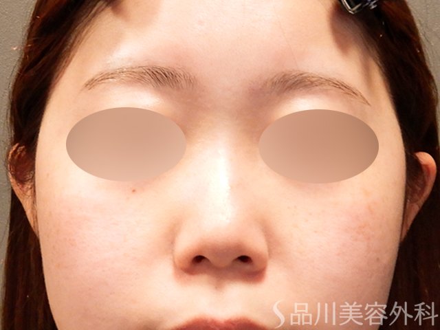 症例NO.69518のBEFORE写真