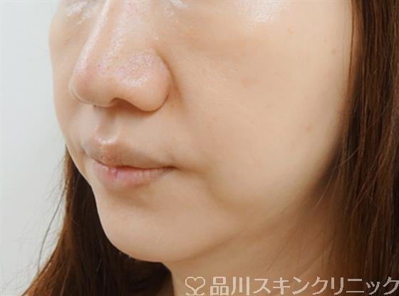 症例NO.25723のBEFORE写真