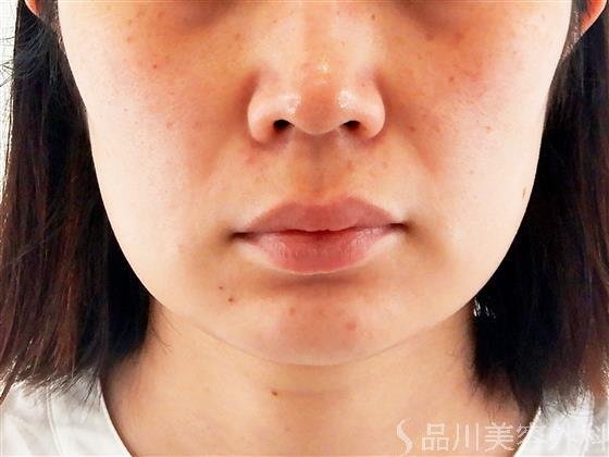 症例NO.56626のBEFORE写真