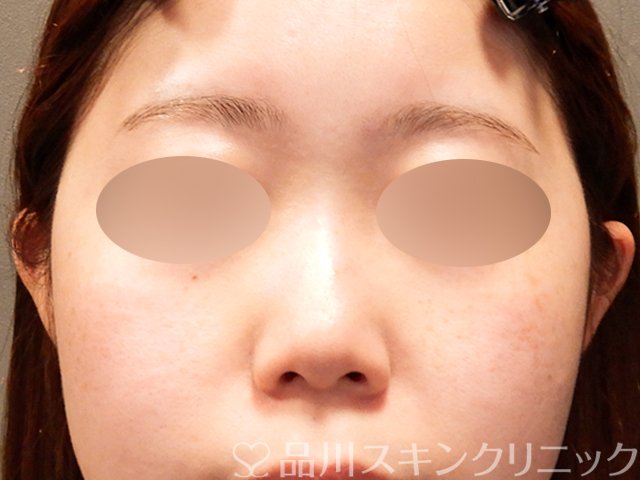 症例NO.69518のBEFORE写真