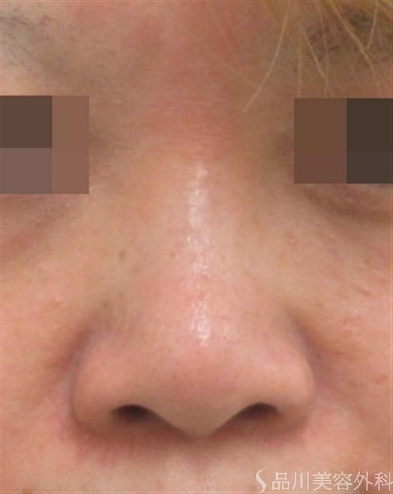 症例NO.23857のBEFORE写真