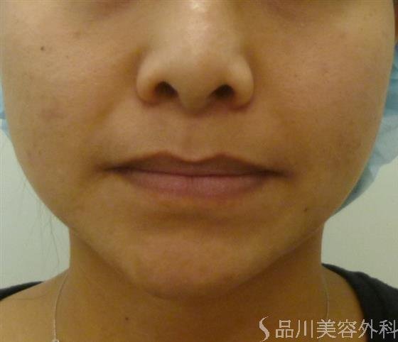 症例NO.31296のBEFORE写真