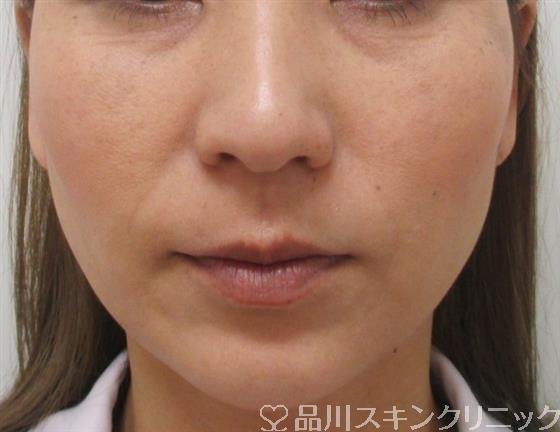 症例NO.27302のAFTER写真