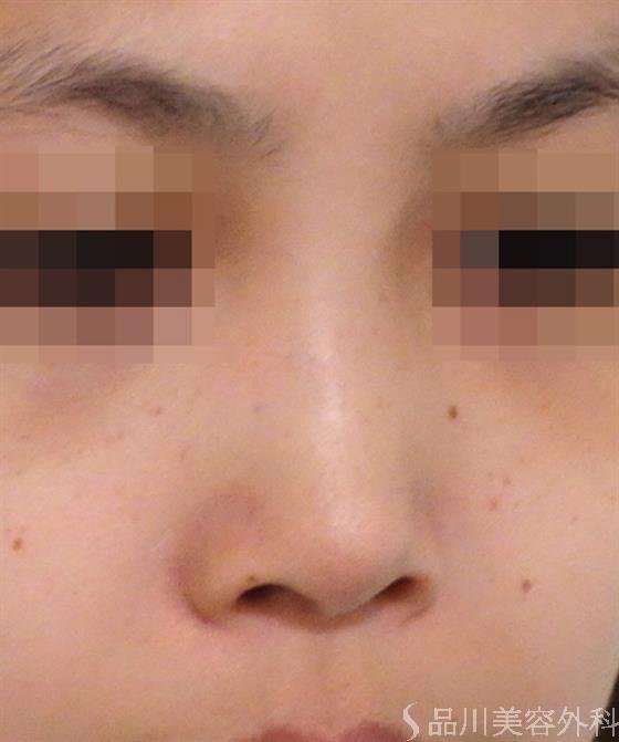 症例NO.38169のBEFORE写真