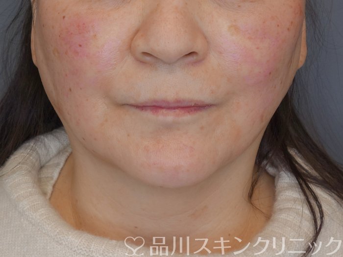 症例NO.72593のAFTER写真