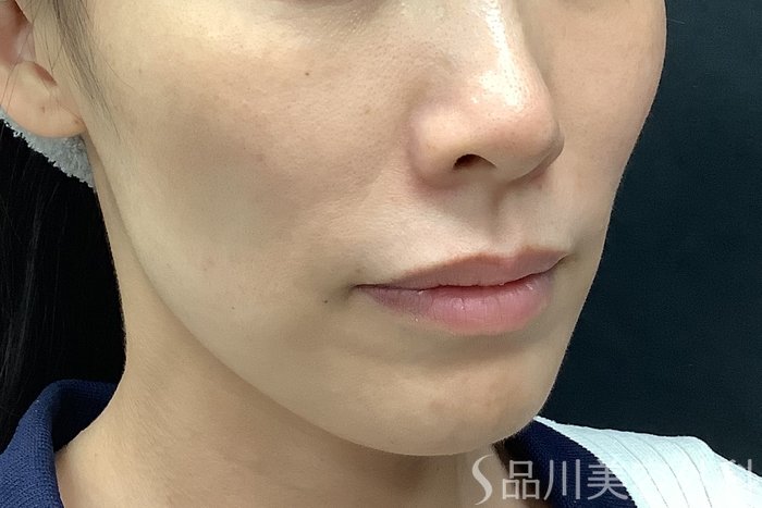 症例NO.71531のBEFORE写真