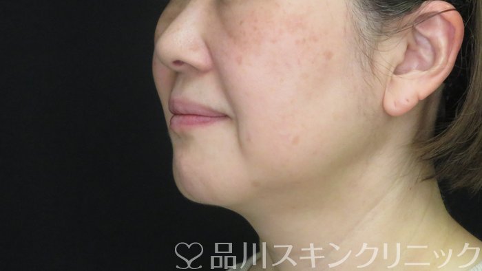 症例NO.73056のBEFORE写真