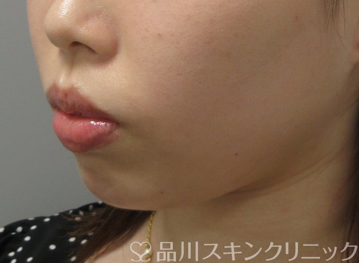 症例NO.70805のBEFORE写真
