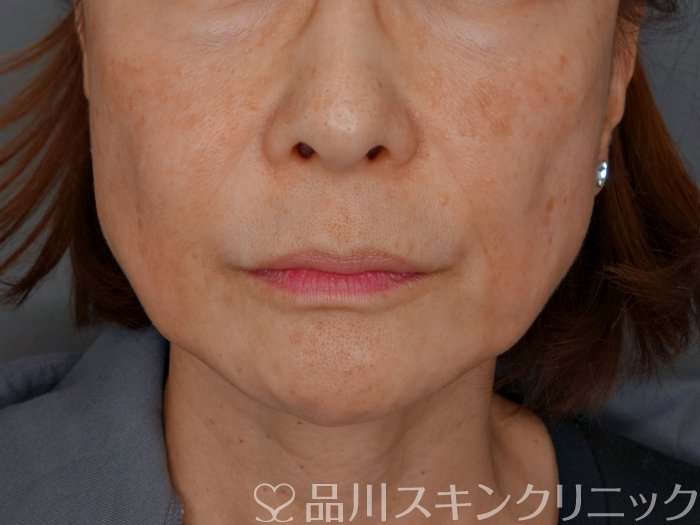 症例NO.73061のBEFORE写真