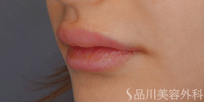 症例NO.72422のAFTER写真