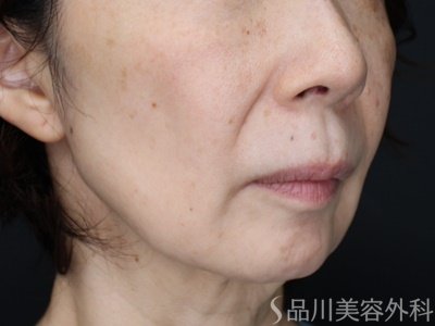 症例NO.71302のBEFORE写真