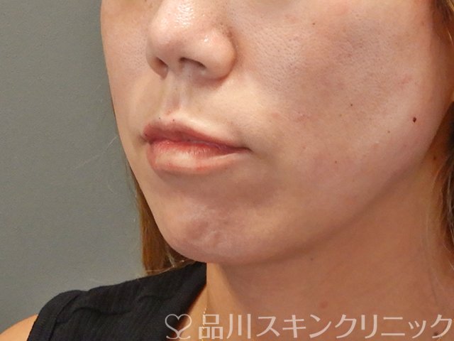 症例NO.75039のAFTER写真