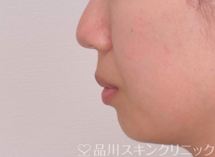 症例NO.67764のBEFORE写真