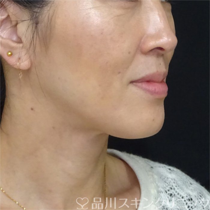 症例NO.69694のBEFORE写真