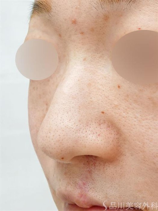 症例NO.46596のBEFORE写真