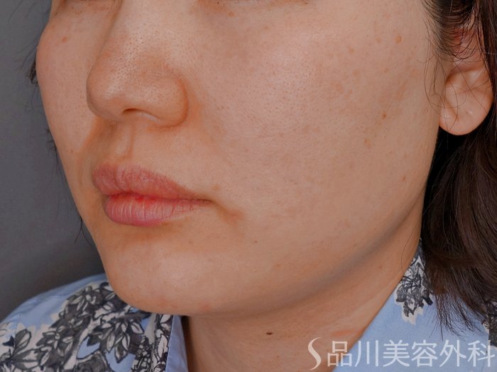 症例NO.73584のBEFORE写真