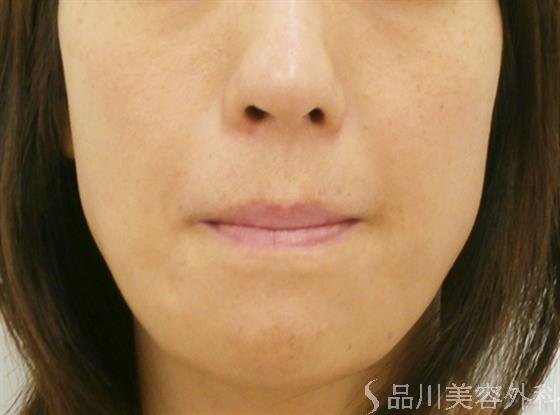 症例NO.30986のBEFORE写真