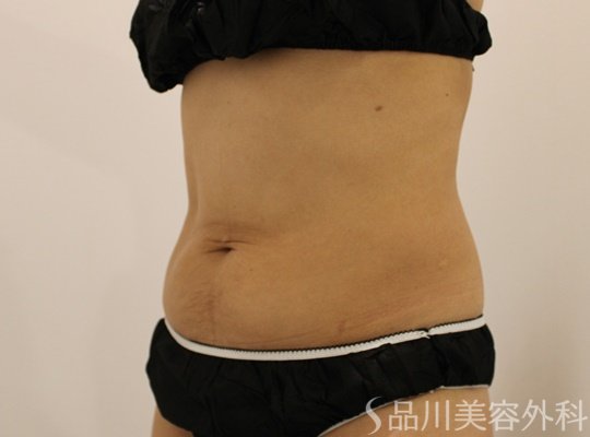 症例NO.71797のAFTER写真