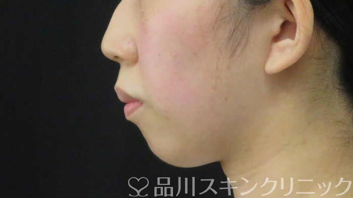 症例NO.72117のBEFORE写真