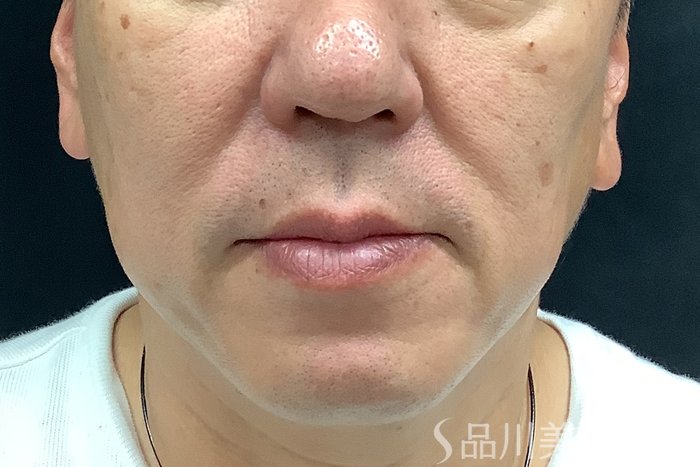 症例NO.73308のBEFORE写真