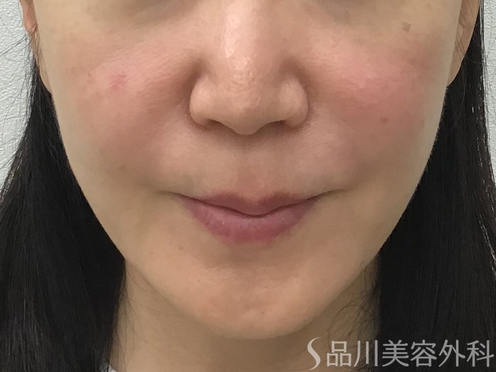 症例NO.62261のAFTER写真