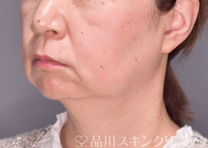 症例NO.69420のBEFORE写真