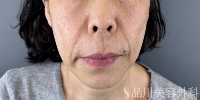 症例NO.72554のAFTER写真