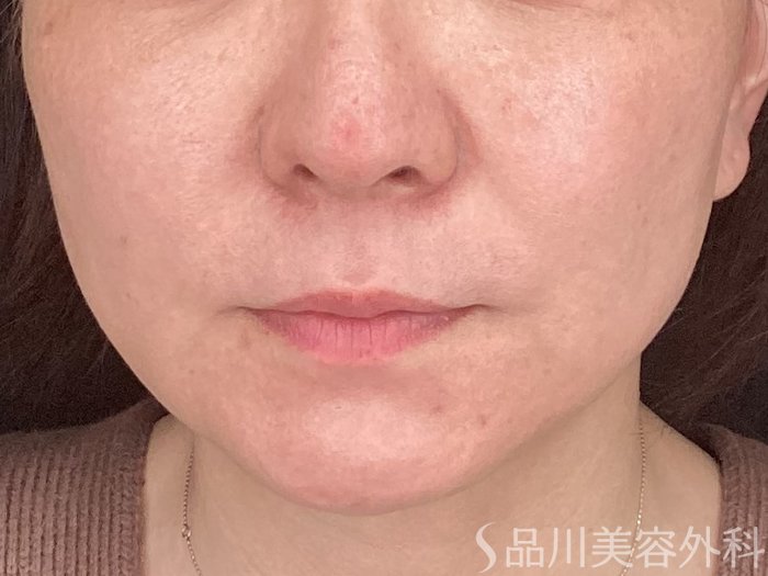 症例NO.64959のBEFORE写真