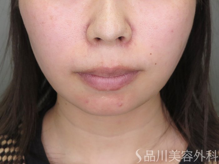 症例NO.71460のAFTER写真